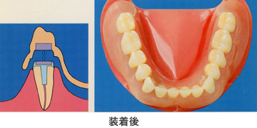 磁性アタッチメント